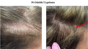 Dht blocker for hair regrowth. Turkey Hair Growth Product Follicle Thought