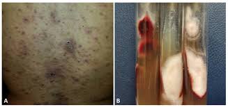 Image result for penis mycosis symptoms