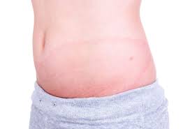Lyme Disease A Whole Person Approach Naturopathic Doctor News And Review