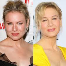 There has been a lot of talk about trey gowdy getting a nose job. Renee Zellweger S Plastic Surgery Gets Weighed In On By Experts