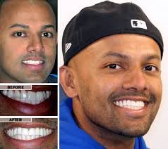 Kendra schick at evolution dental understands that paying the full cost of porcelain veneers up front may not be a feasible option for many patients. Dental Veneers Brooklyn Porcelain Veneers Teeth Press On Veneers