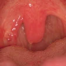 Maybe you would like to learn more about one of these? Causes And Treatment For A Swollen Uvula With Pictures Youmemindbody