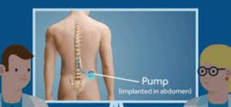 Image result for Intrathecal Pump