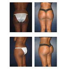 Pin On Scoop Lift Brazilian Butt Lift