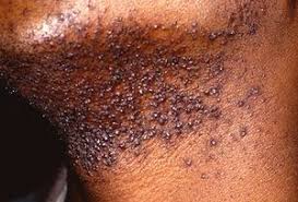 An ingrown hair cyst is a hair follicle cyst. Pseudofolliculitis Barbae Wikipedia