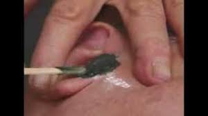 A chemical compound suspended in a gel or cream. Ear Hair Removal For Men Your Options Hair Free Life