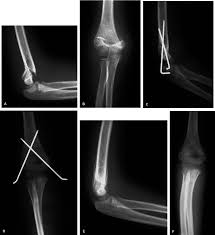 Image result for Fall on Outstretched Hand