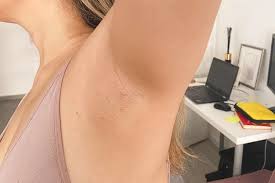 Safety guaranteed with the skin tone. Kenzzi Laser Hair Removal Experience With After Pics Sarah Chetrit S Lust Till Dawn