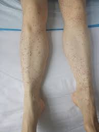 The most striking feature of this form of vasculitis is a purplish rash, typically on the lower legs and buttocks. A Boy With Purpura On The Legs The Bmj