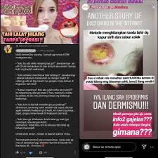 Berikut 8 cara menghilangkan tahi lalat secara alami. Penjelasan Dokter Tentang Hilangkan Tahi Lalat Pakai Kapur Sirih Sabun Colek