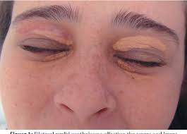 Image result for xantelasma