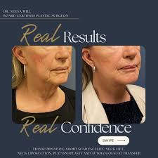 Real results, real confidence. This elegant facial rejuvenation was  performed by Dr. Neena Will, double board-certified facial plastic and  reconstructive surgeon. Through a personalized combination of short scar  facelift, neck lift with