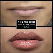 Superbly placed , what a stunning, natural transformation · 09/02/2022. Crazy Beautiful Lips From London Using A Cannula To Get A Similar Effect You Re Likely To Need 2 3ml Of Lip Fill Lips Inspiration Beautiful Lips Lip Fillers