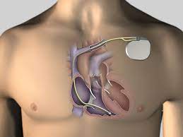 When it detects a very fast, abnormal heart rhythm, it delivers energy to the heart muscle. Implantierbarer Defibrillator Icd Hgz Gottingen