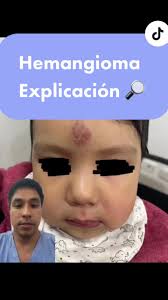 Hemangioma Cabeza