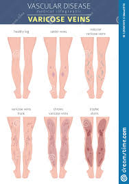Vascular Diseases Varicose Veins Symptoms Treatment Icon Set Stock Vector Illustration Of Flow Illness 125301572