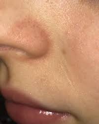 Sicheres zahlen · trustedshops zertifiziert · geld zurück garantie What Could Be Causing This Redness Around The Sides Of My Nose Doesn T Itch At All And I Ve Had It For Years Sometimes The Skin Is Also Flaky And I Also Have