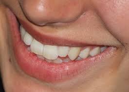 How soon after a tooth extraction can i have something put in to replace it? Miami Orthodontist Explains Orthodontic Relapse