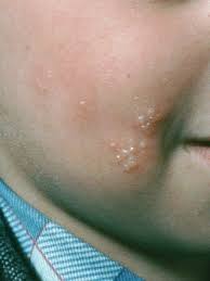 The sores are usually described as an outbreak, with the first outbreak occurring within weeks of exposure to. Herpes Simplex Dermatologist In Dartmouth Ma Dartmouth Dermatology