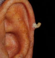 Image result for cornu cutaneum)