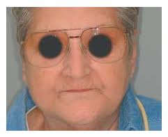 Elaboración de Prótesis Totales: Presentación de Caso Clínico