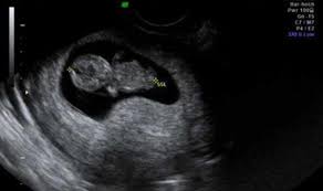 Schwangerschaftswoche und 3 tage 8 ssw. Ultraschall In Der 8 Bis 12 Ssw Netdoktor At