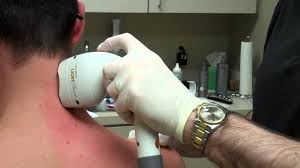 The hair colors that respond best to laser hair removal are dark colors, like black and brown. Treating Man S Shoulders Neck With Laser Hair Removal Youtube
