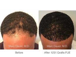If you are african or have significant african ancestry, your hair may take a long time to grow and, in some cases, might even be prone to unwanted breakage. Fue Hair Transplant In African American Patient Marc Dauer Md Hair Transplant Doctor Los Angeles