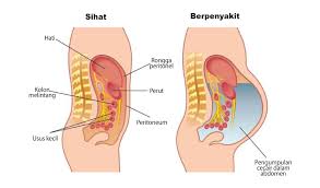 Kanser payudara merupakan kanser yang kerap berlaku and juga merupakan punca kematian kanser utama bagi wanita di. Derita Hati Berparut