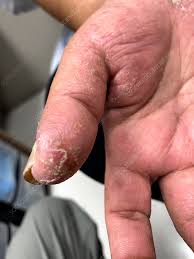 Image result for dyshidrosis