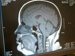 My Brain Mri Before Chiari Decompression Surgery 13mm Chiari Encouragement My Brain