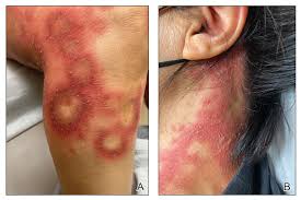 Image result for Pustular Psoriasis