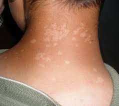 The majority of tinea versicolor is caused by the fungus malassezia globosa, although malassezia furfur is responsible for a small number of cases. Pin On Imj Dermatology
