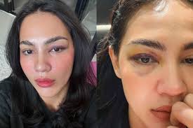 Saya jatuh,terkena bucu kerusi