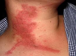Image result for dermatitis contacta allergica