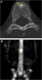 20,450 likes · 950 talking about this · 91 were here. Bone Up On Spinal Osseous Lesions A Case Review Series Insights Into Imaging Full Text