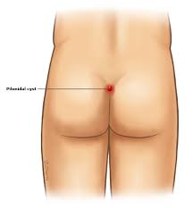 Try hair removal cream, which you can find at your local drugstore. Causes For Bumps On Buttocks Getting Rid Of Cyst Boils On Butt