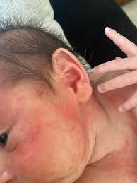 Image result for yellow scabs on the face in children
