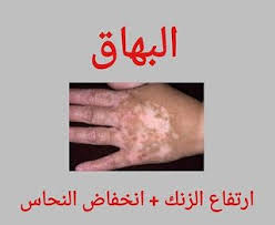 البهاق هو اضطراب جلدي يظهر على شكل بقع بيضاء خالية من الصبغة والسبب هو ضعف صبغة الميلانين من المسؤول عن الميلانين مع Blog Blog Posts Detox