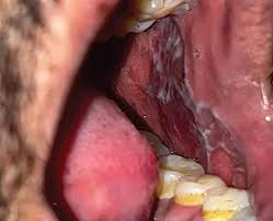 Image result for Mouth ulcers roof of mouth