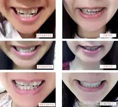 香港牙科醫學院院士(牙齒矯正科)專科 fellow of the college of dental surgeons of hong kong in the specialty of orthodontics. å¸¦ç‰™ç®å‰åŽçš„å›¾ç‰‡ æœç‹—å›¾ç‰‡æœç´¢