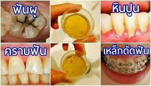 ผมร่วง ฟันผุ - #ปากเหม็น #ฟันเหลือง #มีหินปูน... | Facebook