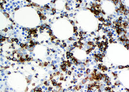 Genetically, it is characterized by a stepwise acquisition of somatic mutations. Pathology Outlines Extranodal Nk T Cell Lymphoma Nasal Type
