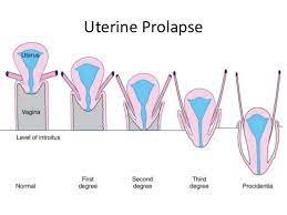 Bila keputihan keluar daripada faraj, ia membatalkan wuduk. Prolapsed Uterus Rahim Jatuh Rahim Longgar Sn Nur Nabiila Masfuzah Abdullah The Malaysian Medical Gazette