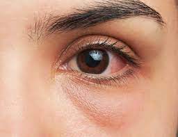 Selain cara mengobati mata merah secara alami seperti diatas, tentunya masih banyak juga bahan alami untuk sebagai tambahannya mari lihat 10 tips untuk 10 tips mengobati mata merah. 16 Penyebab Mata Merah Dan Cara Mengobatinya Honestdocs