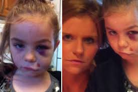 Mum slams primary school after daughter caused 'permanent' damage to her  eye after horror fall from climbing frame