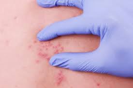 Dia takut bekas tu selamanya di muka umi! Mirip Cacar Ruam Lenting Isi Air Bisa Jadi Gejala Herpes Zoster