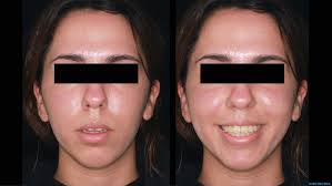 MARPE-BAME: Expansión palatina rápida.