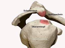 Bigliani, l.u., morrison, d.s., april, e.w. Das Impingement Der Schulter