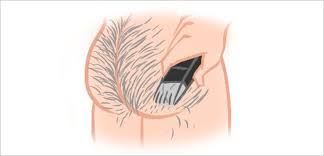 Best butt hair removal cream. How To Shave Your Butt Illustrated Bellatory